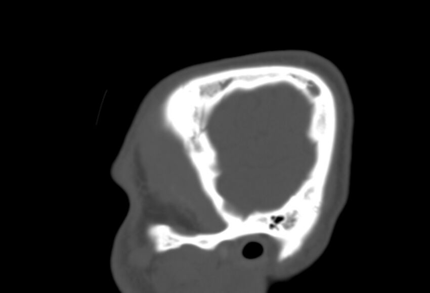 Asymptomatic occipital spur (Radiopaedia 87753-104201 Sagittal bone window 17).jpg