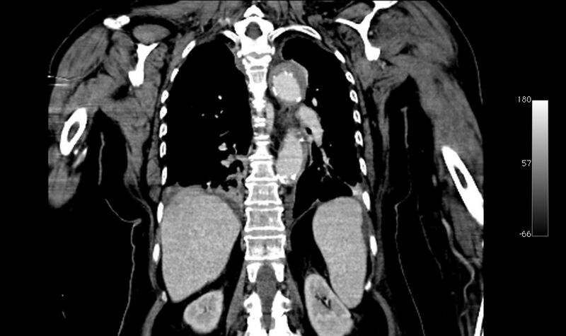 File:Atypical dissection of the thoracic aorta (Radiopaedia 10975-78320 B 32).jpg