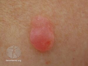 Atypical fibroxanthoma (DermNet NZ lesions-afx4).jpg