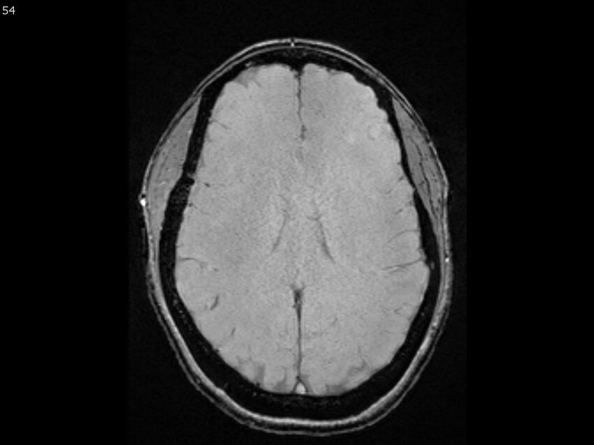 Atypical meningioma - intraosseous (Radiopaedia 64915-74572 Axial SWI 54).jpg