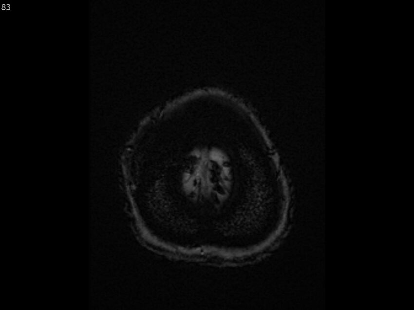 Atypical meningioma - intraosseous (Radiopaedia 64915-74572 Axial SWI 83).jpg