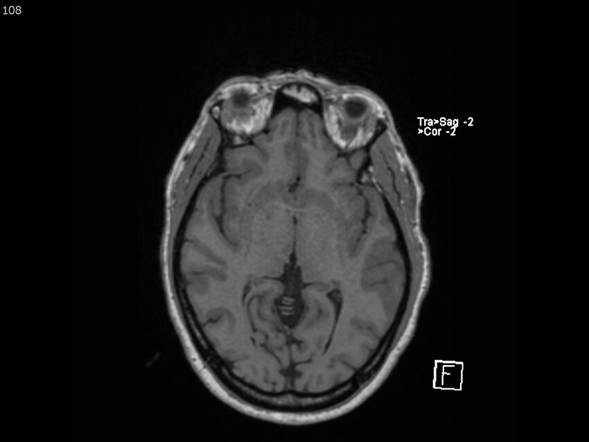 Atypical meningioma - intraosseous (Radiopaedia 64915-74572 Axial T1 108).jpg