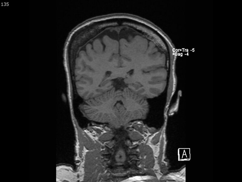 File:Atypical meningioma - intraosseous (Radiopaedia 64915-74572 Coronal T1 135).jpg