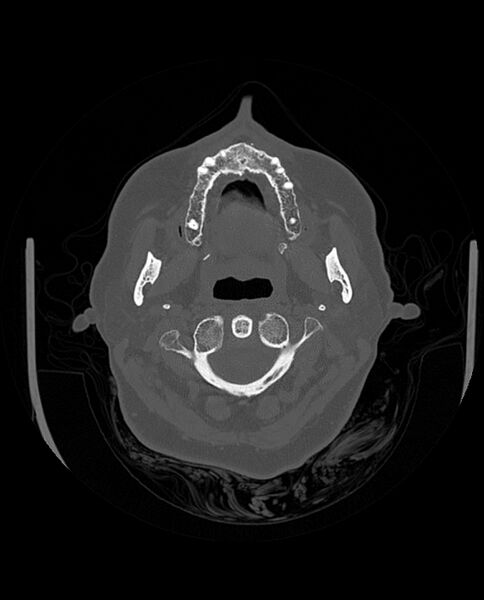 File:Automastoidectomy with labyrinthine fistula (Radiopaedia 84143-99411 Axial non-contrast 32).jpg
