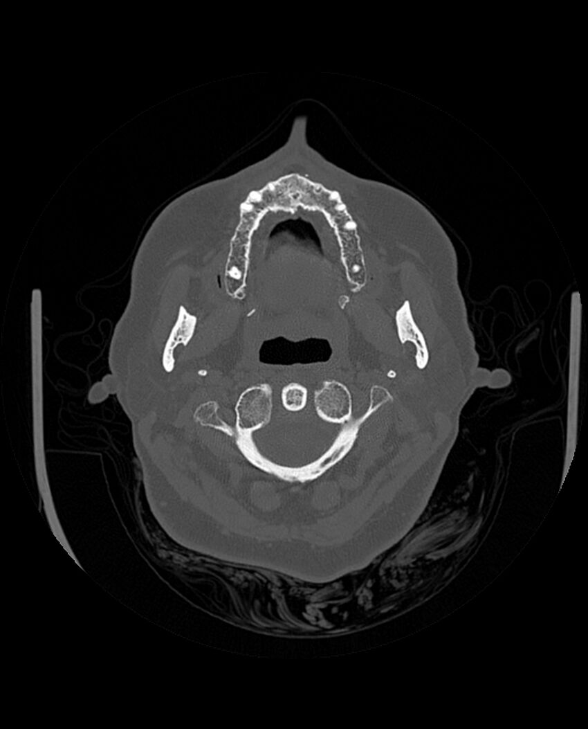 Automastoidectomy with labyrinthine fistula (Radiopaedia 84143-99411 Axial non-contrast 32).jpg