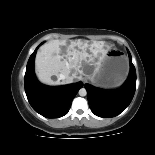 File:Autosomal dominant polycystic kidney disease (Radiopaedia 23061-23093 C 9).jpg