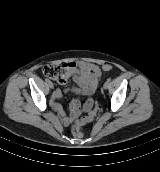 File:Autosomal dominant polycystic kidney disease (Radiopaedia 41918-44922 Axial non-contrast 31).jpg