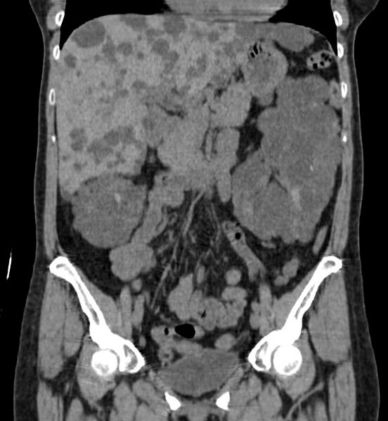 File:Autosomal dominant polycystic kidney disease (Radiopaedia 41918-44922 Coronal non-contrast 14).jpg