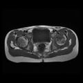Avascular necrosis of the hip (Radiopaedia 29563-30067 Axial T1 7).jpg