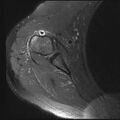Avulsion fracture - greater tuberosity of humerus (Radiopaedia 71216-81515 Axial PD fat sat 5).jpg