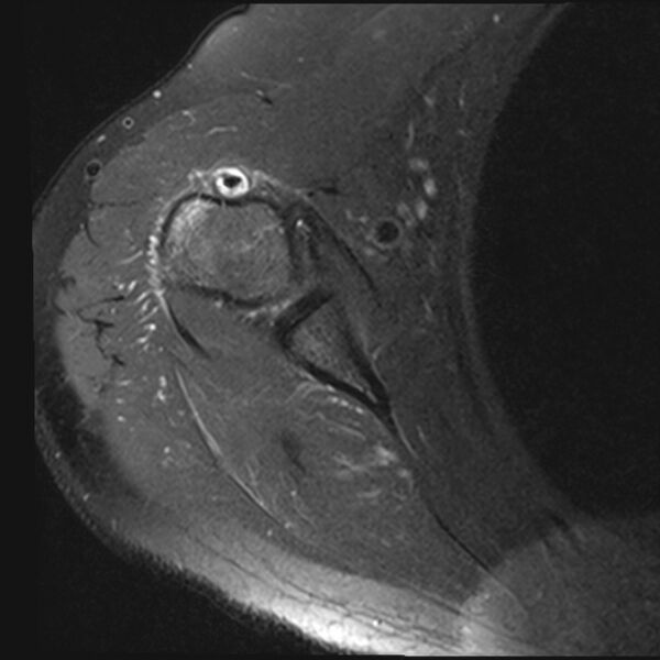 File:Avulsion fracture - greater tuberosity of humerus (Radiopaedia 71216-81515 Axial PD fat sat 5).jpg