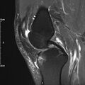 Avulsion fracture of the fibular head (Radiopaedia 74804-85808 Sagittal PD fat sat 15).jpg
