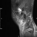 Avulsion fracture of the fibular head (Radiopaedia 74804-85808 Sagittal PD fat sat 30).jpg