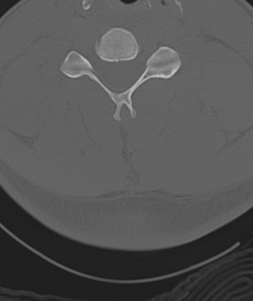 File:Axis peg fracture (type 3) and atlas lateral mass (type 4) fracture (Radiopaedia 37474-39324 Axial bone window 33).png