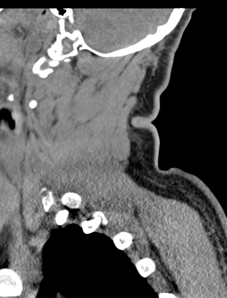 File:Axis peg fracture (type 3) and atlas lateral mass (type 4) fracture (Radiopaedia 37474-39324 D 17).png