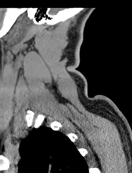 File:Axis peg fracture (type 3) and atlas lateral mass (type 4) fracture (Radiopaedia 37474-39324 D 67).png