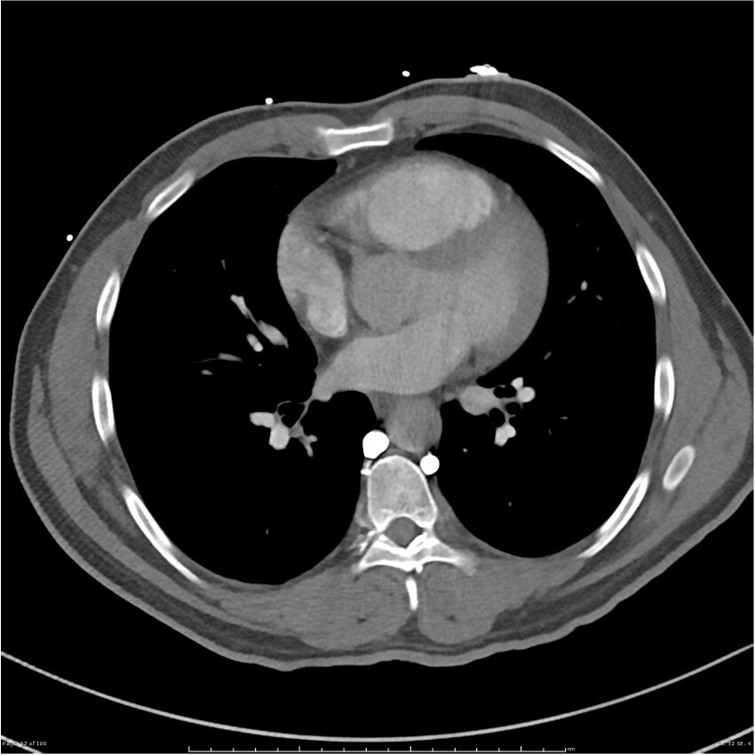 Azygos venous system anatomy (CT pulmonary angiography) (Radiopaedia 25928-26077 Axial C+ CTPA 52).jpg