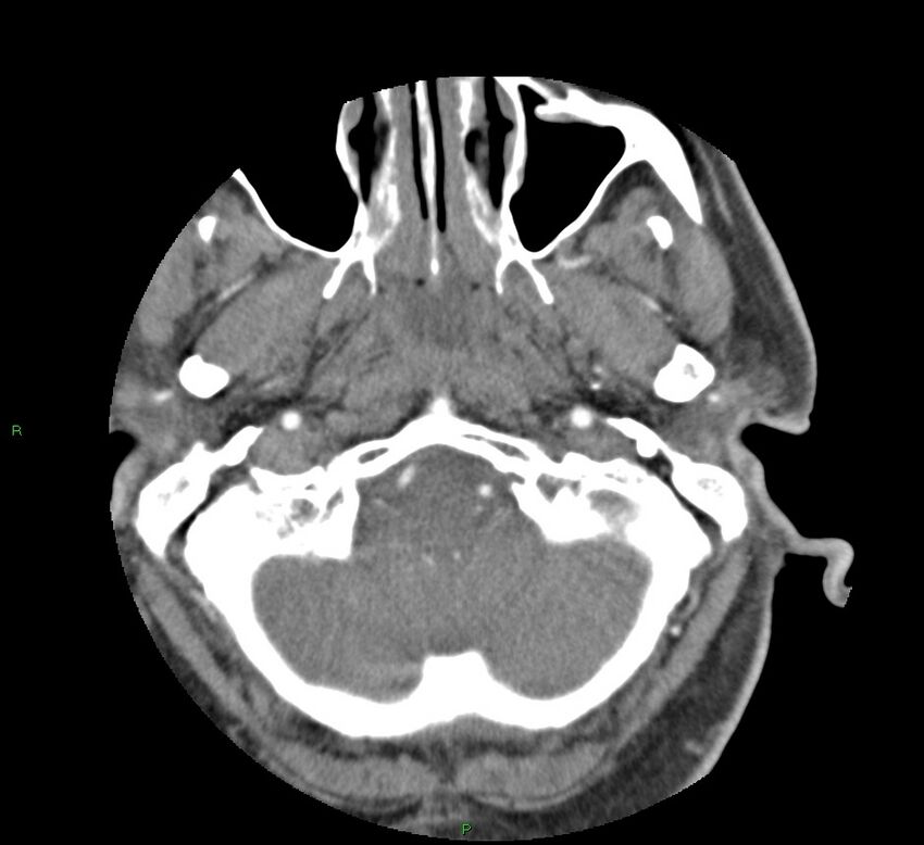 Basal ganglia hemorrhage (Radiopaedia 58763-65985 D 24).jpg