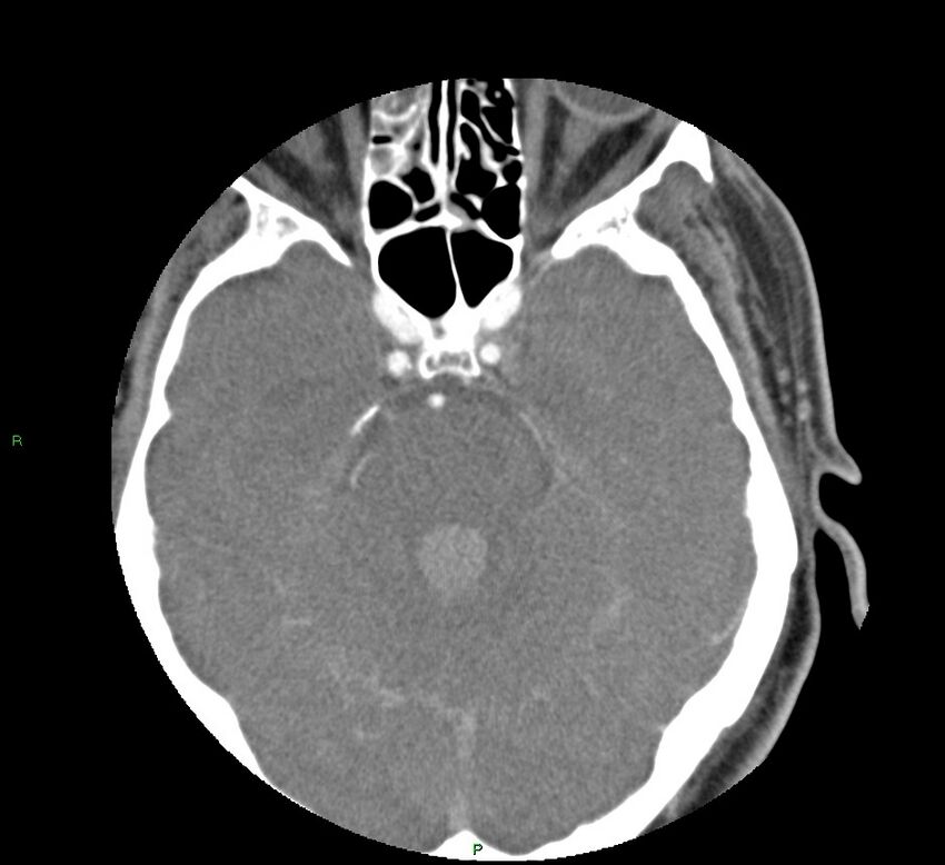 Basal ganglia hemorrhage (Radiopaedia 58763-65985 D 63).jpg