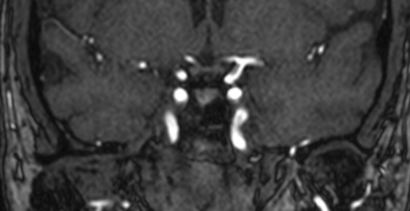 File:Basilar artery fenestration (Radiopaedia 74537-85455 Coronal MRA TOF 14).jpg
