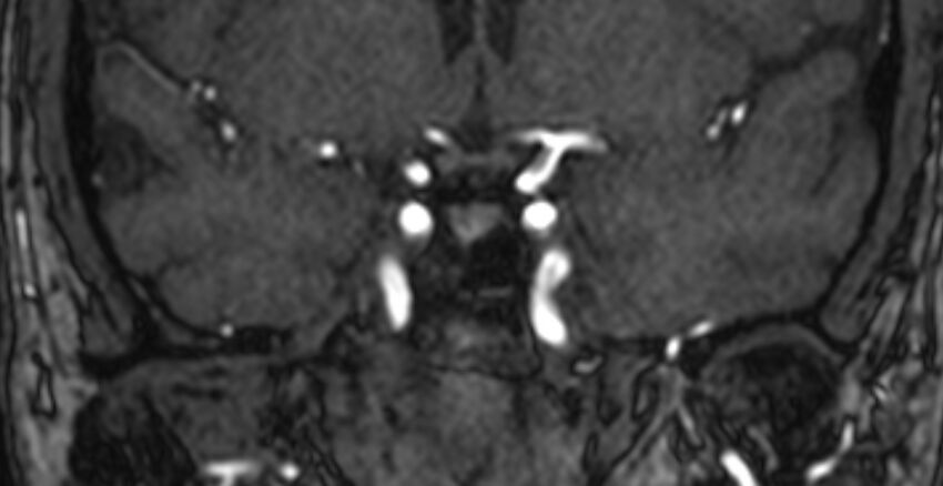Basilar artery fenestration (Radiopaedia 74537-85455 Coronal MRA TOF 14).jpg