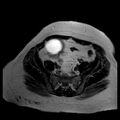 Benign seromucinous cystadenoma of the ovary (Radiopaedia 71065-81300 B 13).jpg