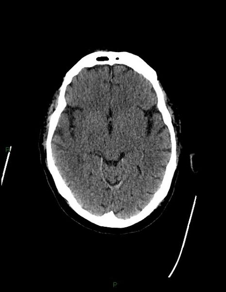 File:Bilateral acute middle cerebral artery territory infarcts (Radiopaedia 77319-89401 Axial non-contrast 37).jpg