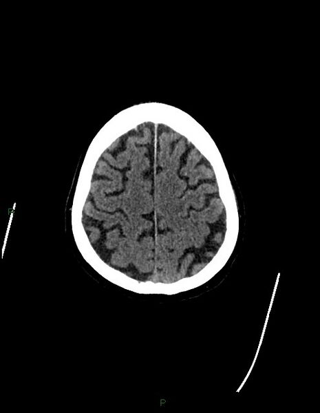 File:Bilateral acute middle cerebral artery territory infarcts (Radiopaedia 77319-89401 Axial non-contrast 74).jpg