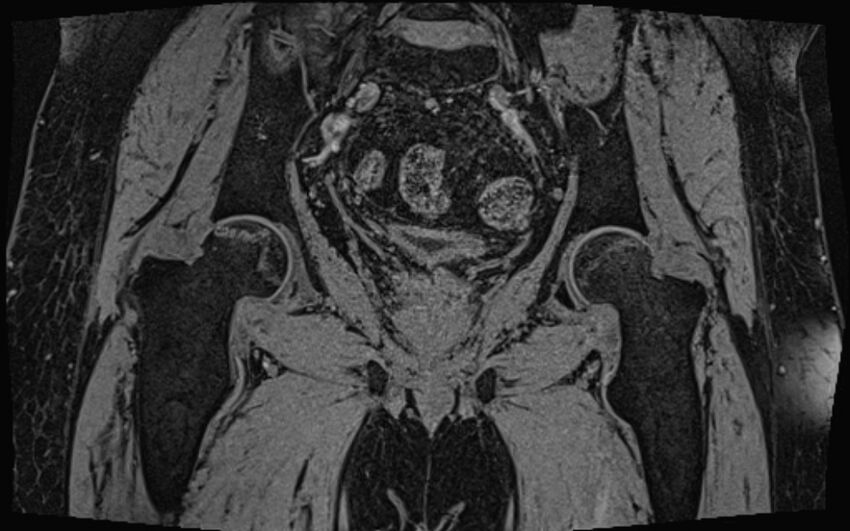 Bilateral avascular necrosis of femoral head (Radiopaedia 77116-89078 Coronal T2 we 27).jpg