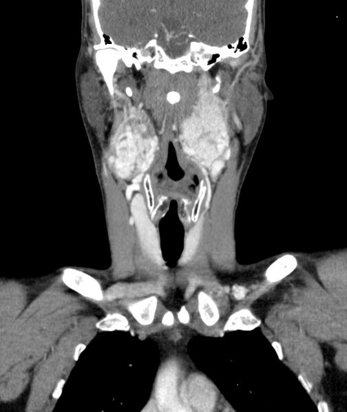 File:Bilateral carotid body tumors (Radiopaedia 52899-58827 B 19).jpg