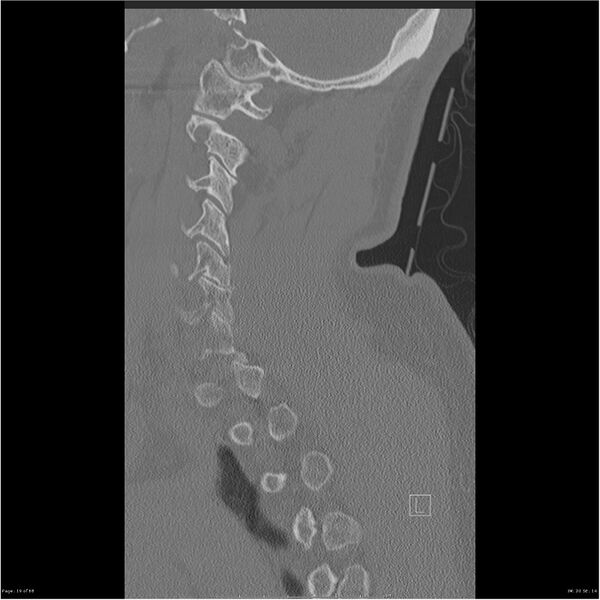 File:Bilateral cervical ribs (Radiopaedia 25868-26017 Sagittal bone window 19).jpg