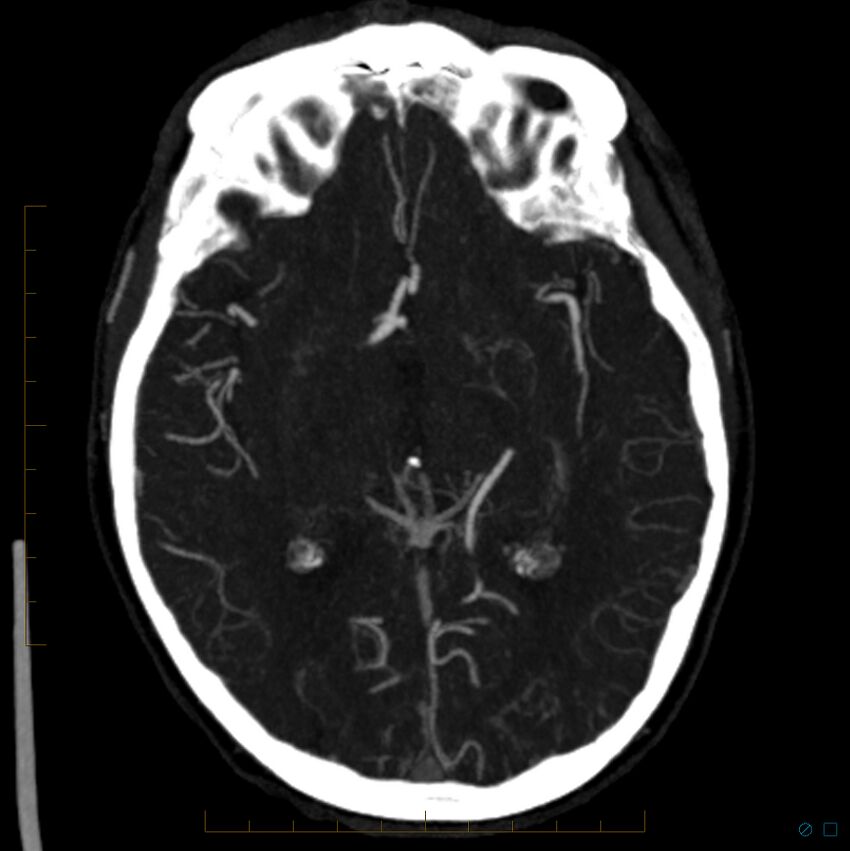 Bilateral chronic common carotid occlusion (Radiopaedia 50849-56362 D 16).jpg