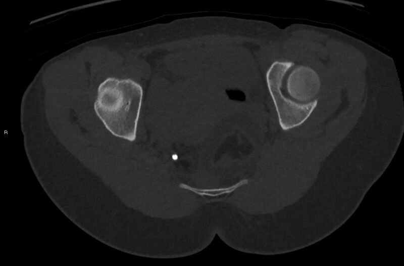 File:Bilateral mature cystic ovarian teratoma (Radiopaedia 88821-105592 Axial bone window 34).jpg