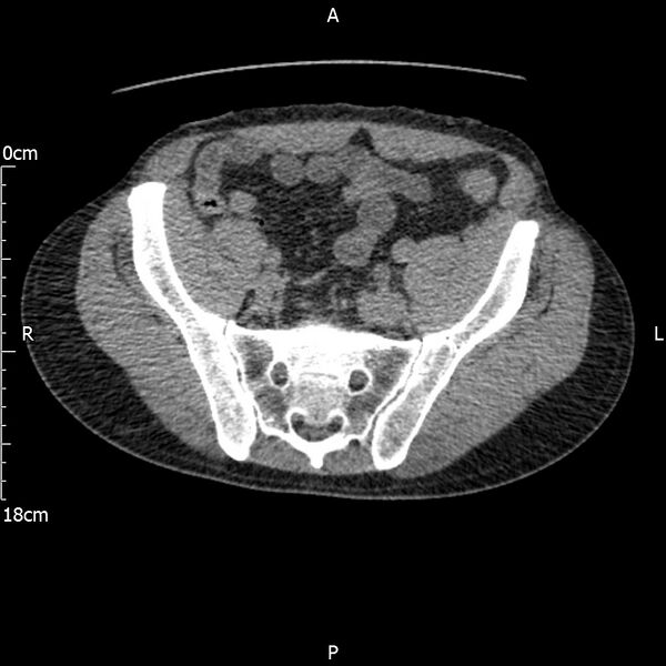 File:Bilateral medullary nephrocalcinosis with ureteric calculi (Radiopaedia 71269-81569 Axial non-contrast 101).jpg