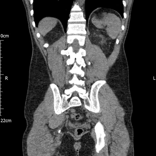 File:Bilateral medullary nephrocalcinosis with ureteric calculi (Radiopaedia 71269-81569 Coronal non-contrast 55).jpg