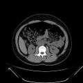 Bilateral ovarian mature cystic teratomas (Radiopaedia 79373-92457 Axial non-contrast 26).jpg