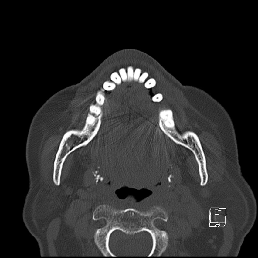 Bilateral palatine tonsilloliths on OPG and CT (Radiopaedia 75167-86247 Axial bone window 44).jpg