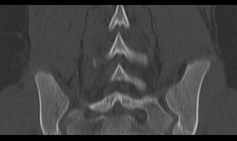 File:Bilateral pars defect (Radiopaedia 26691-26846 Coronal bone window 35).jpg