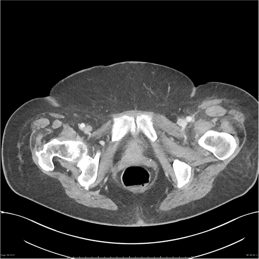 Bilateral psoas hematomas (Radiopaedia 24057-24279 A 88).jpg
