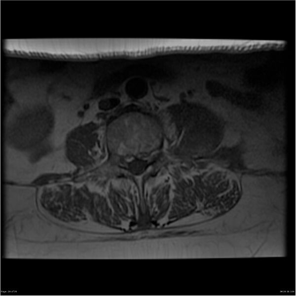 File:Bilateral psoas hematomas (Radiopaedia 24057-24280 T1 26).jpg