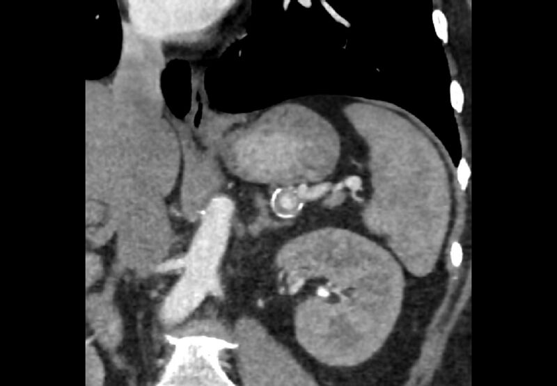 File:Bilateral urolithiasis with incidentally detected splenic artery aneurysm and left inferior vena cava (Radiopaedia 44467-48127 Ob. Cor. C+ Art. 10).jpg