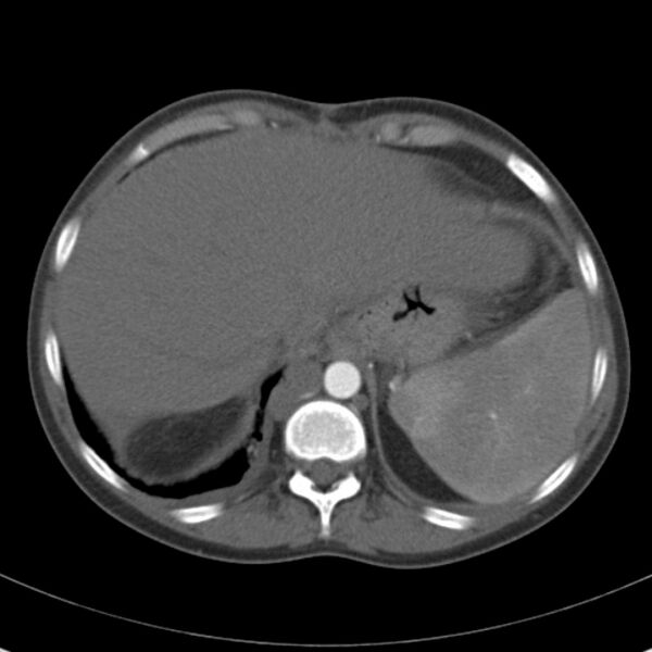 File:Biliary necrosis - liver transplant (Radiopaedia 21876-21846 A 12).jpg