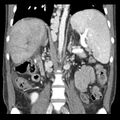Biliary necrosis - liver transplant (Radiopaedia 21876-21846 C 31).jpg