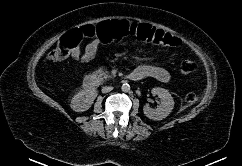 File:Biliary pancreatitis (Radiopaedia 72289-82823 Axial non-contrast 131).jpg