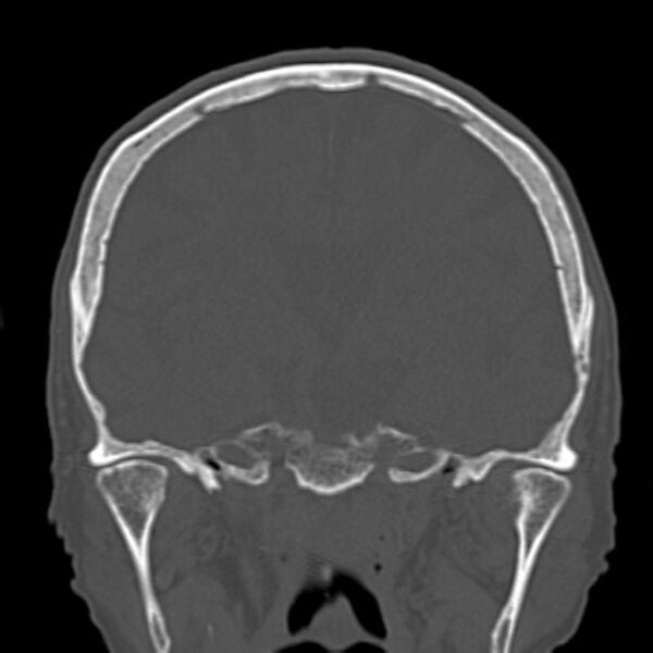 File:Biparietal osteodystrophy (Radiopaedia 46109-50463 Coronal bone window 54).jpg