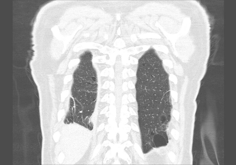 File:Birt-Hogg-Dubé syndrome (Radiopaedia 52578-58491 Coronal lung window 57).jpg