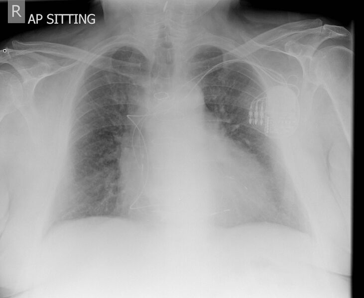 File:Biventricular pacemaker (Radiopaedia 13242).jpg