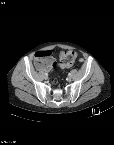 File:Boerhaave syndrome with tension pneumothorax (Radiopaedia 56794-63603 A 52).jpg