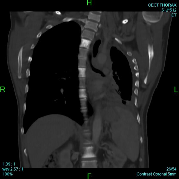 File:Bone metastases from lung carcinoma (Radiopaedia 54703-60937 Coronal bone window 26).jpg
