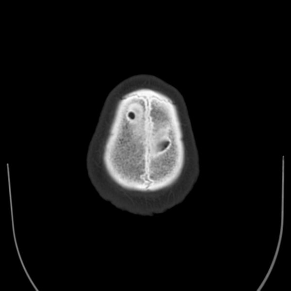 File:Brain Pantopaque remnants (Radiopaedia 78403-91048 Axial bone window 65).jpg